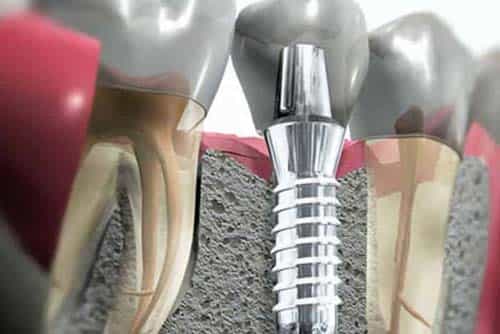 implante-dentario-min-min-min-min